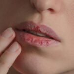 Tips Ampuh Mengatasi Bibir Pecah-Pecah